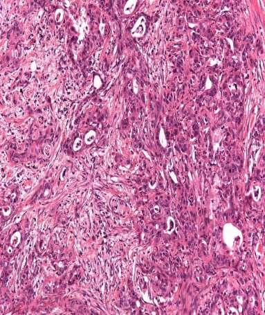 Gastric Carcinoma 11 cases Mean 42 yrs (12-62) Grey-white masses Fibrotic Survivial 1-12 months Peritoneal carcinomatosis 1: Qazi HA, Manikandan R, Foster CS, Fordham MV.