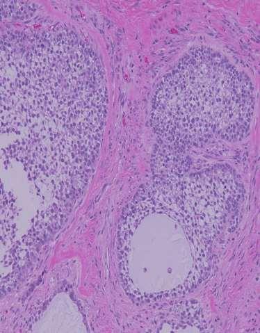 Granulosa Cell Tumor Rare, 45 cases Mean 40 years (14-87 yrs) Gynecomastia Microfollicles, Sheets Small, uniform cells Nuclear grooves Minimal cytoplasm Discohesive 1 sarcomatous degeneration, 1