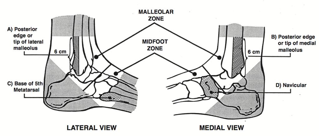 OTTOWA ANKLE a) An ankle x-ray series is only required if there is any pain in malleolar zone and any of these findings: 1. bone tenderness at A OR 2. bone tenderness at B OR 3.