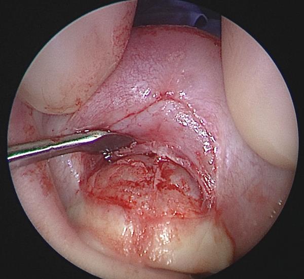 Postoperative nasal stenting is the norm, although the optimal duration for stenting is a matter of debate. Balloon dilatation has also been used 3.