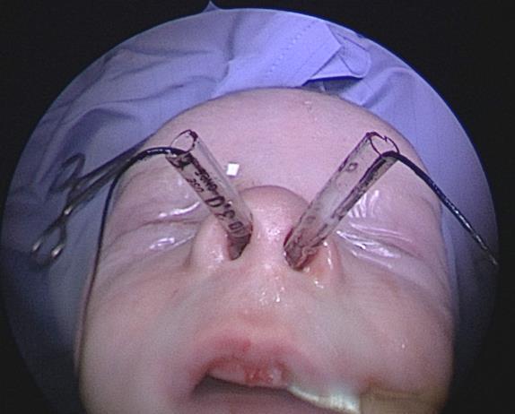 septum and secures the stents in each nasal cavity o It also obviates the need for posterior suturing of the tubes and allows for removal of the tubes in outpatients by simply cutting the anterior