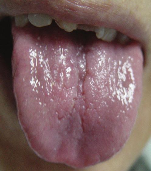 2 Evidence-Based Complementary and Alternative Medicine (a) (b) (c) (d) (e) (f) Figure 1: Typical tongue manifestations in the study.