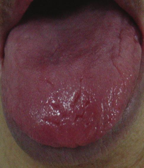 tongue manifestation of turbid phlegm syndrome; (e) and (f) common tongue manifestation of blood stasis syndrome. of ischemic heart disease.