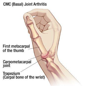Understanding yur thumb stearthritis Intrductin The CMC jint is ne f the mst imprtant jints f the thumb and hand due t its wide range f mtin.