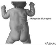 Skin Characteristics Mongolian spots: Dark blue area in the darkly pigmented infant and children It tend to fade by the time a child is 5 years old http://www.nlm.nih.