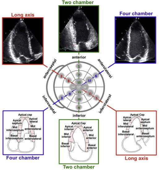 Hình 4 Định hướng của 4 buồng từ mỏm tim (A4C), 2 buồng từ mỏm (A2C), và trục dọc từ mỏm (ALX) liên quan đến sự phân bố kiểu mắt bò của các vùng thất trái (giữa).