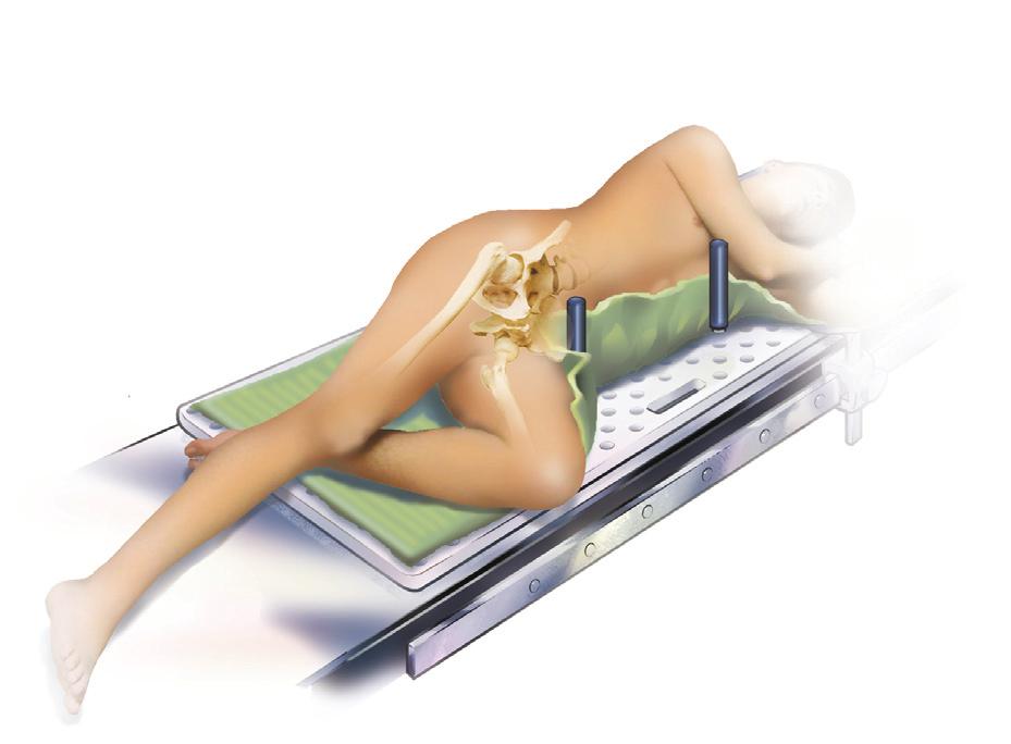 Taperloc Complete Hip Stem Figure 1 Figure 2 Patient Positioning and Surgical Approach The goal of the surgical approach is to establish adequate visualisation of the anatomy to evaluate stability