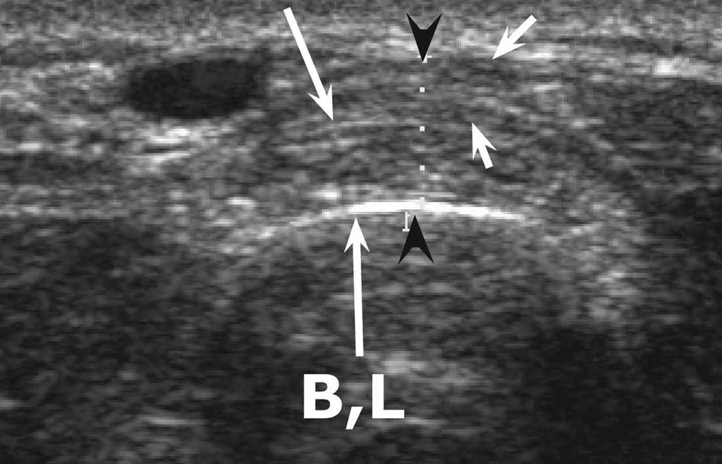 Normal thickness at the intersection area is best appreciated in the transverse plane at the crossover point (arrowheads). Peritendinous contrast enhancement also has been reported.