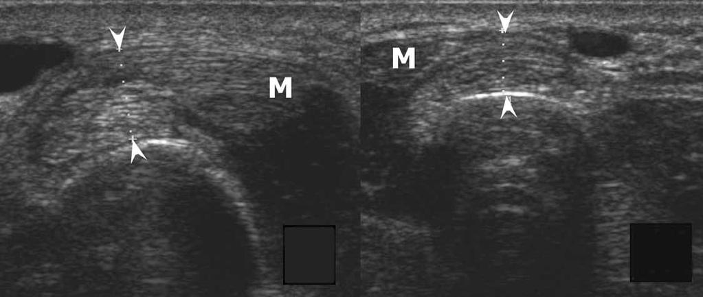 De Maeseneer et al Figure 23. Sonogram from a 45-year-old woman. Clinical symptoms included pain, tenderness, and swelling.