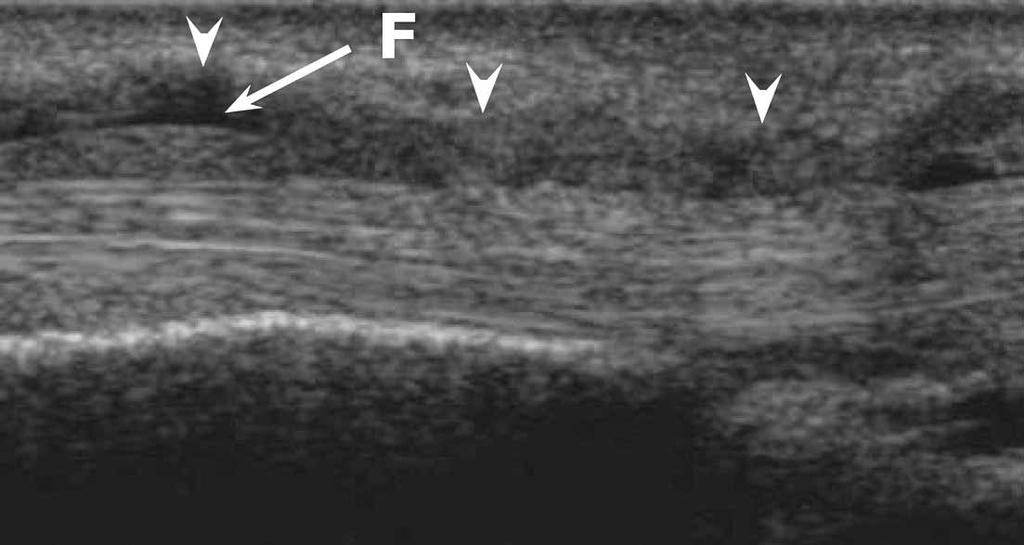 be differentiated from each other. Sonography is a valuable technique for diagnosing de Quervain tenosynovitis, intersection syndrome, and Wartenberg syndrome. Figure 22.