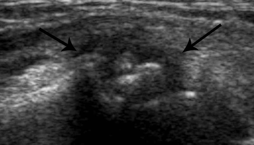 Hoch J, Fritch H, Lewejohann S. Congenital or acquired disposition of the separate compartment of the extensor pollicis brevis tendon associated with stenosing tendovaginitis (de Quervain disease)?