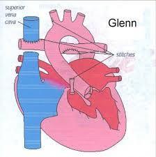 Bidirectional Glenn Shunt Decreases volume load on single ventricle Relieves cyanosis, correct