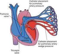 Glenn Physiology Transpulmonary Gradient: Pulmonary artery pressure minus