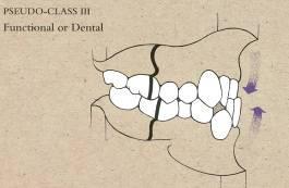 Class III malocclusion (mesioclusion) - The mesiobuccal groove of the mandibular first molar occludes mesial to the mesiobuccal cusp of the maxillary first molar (see figures 21, 22). fig. 21 fig.