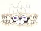 Supernumerary tooth positioned between the permanent maxillary central incisors (see figure 32). Fig.