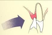 Each contact area has four embrasures: Gingival Occlusal, Incisal Lingual Buccal, Labial Embrasures provide spillways for food and prevent food impaction (see figures 65 & 66). Fig.