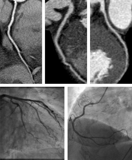 Figure 2 Dual-source CT coronary angiography in the step-and-shoot mode in a 63-year-old woman with suspected coronary artery disease (CAD; mean heart rate during scanning 55 bpm, Agatston score 0).