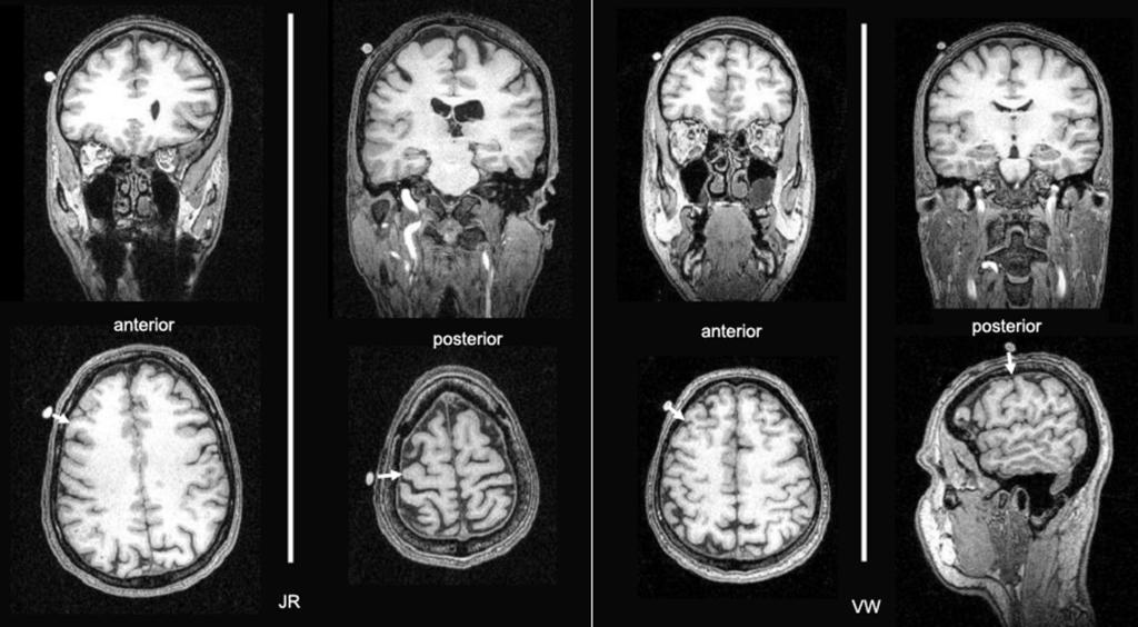 TMS PRODUCES TWO DISSOCIABLE TYPES OF SPEECH DISRUPTION 475 FIG. 2. Structural MRI of subjects J.R. and V.W. The upper images show coronal sections; lower images, horizontal sections (with the exception of the image furthest to the right which is shown in a saggital plane).