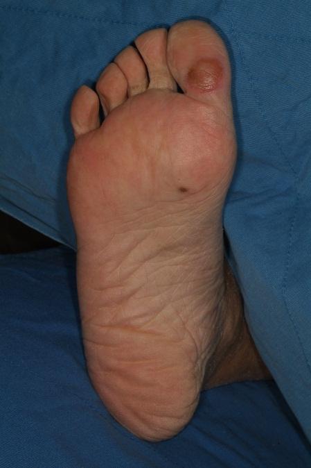 Palmoplantar erythrodysesthesia syndrome Dysesthesia and tingling sensation of palms and soles Well-defined symmetric swelling and erythema; may also affect the lateral