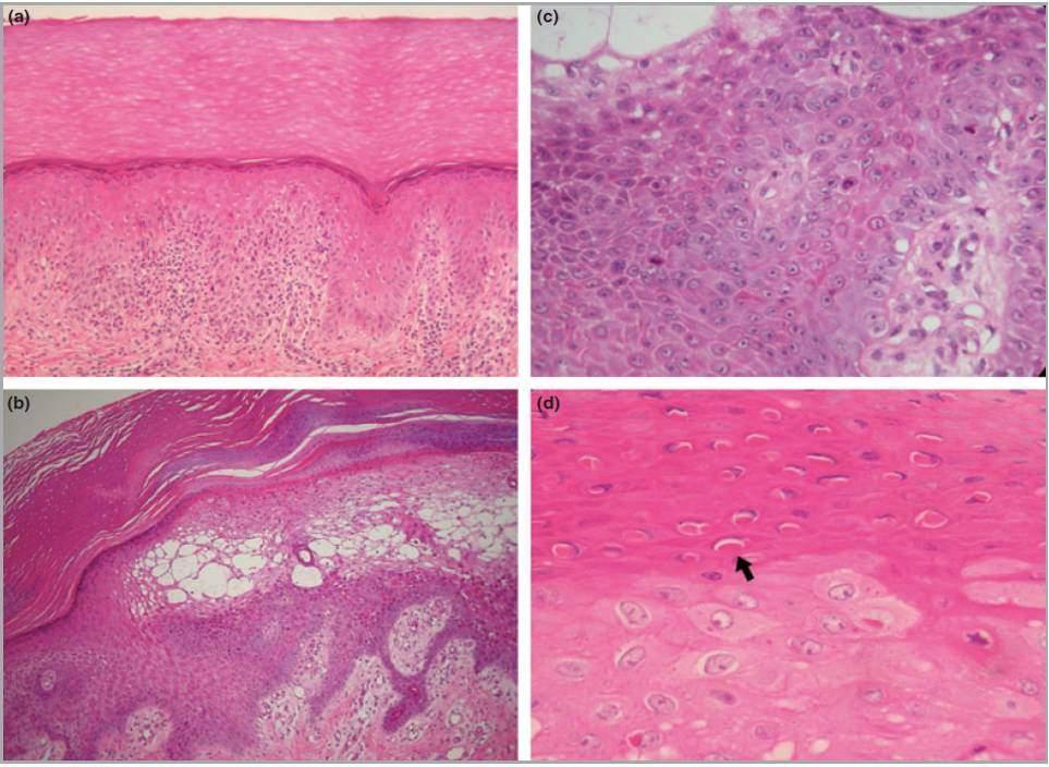 Dermal mononuclear cell infiltrate dyskeratotic