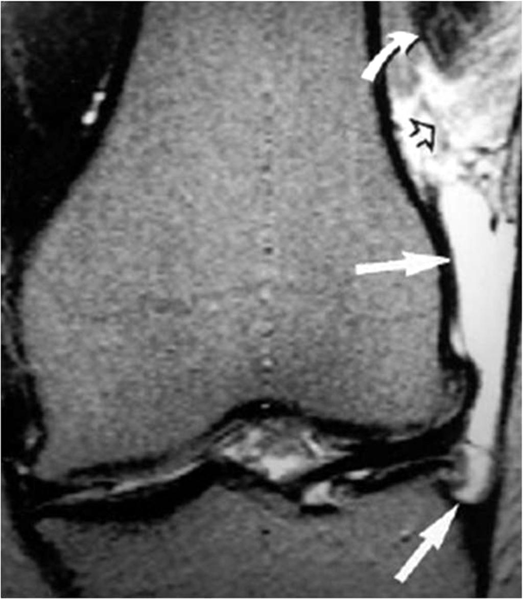 Fig. 7: Coronal T2-weighted fat saturated fast spin-echo MR image demonstrates a high-signal-intensity large cystic fluid collection (straight arrows) medial to the ITB and extending to
