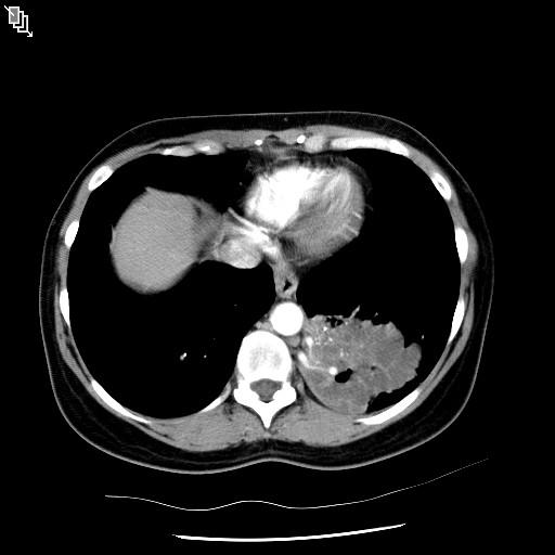 Patient 1 CT with contrast (vessels) Twin