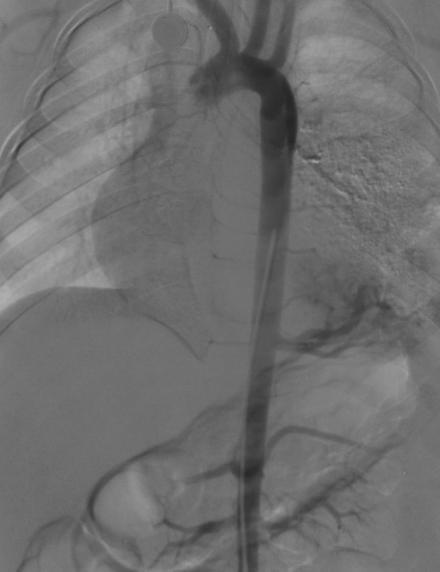 Imaging Pulmonary Sequestrations Conventional angiography is largely being replaced by non-invasive techniques: