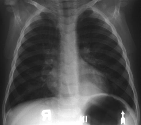 Radiographic Appearance of Extralobar Sequestrations CXR typically shows: Solid retrocardiac opacity rounded or triangular supra or sub-diaphragmatic DDx (in neonate) Diaphragmatic hernia Loculated