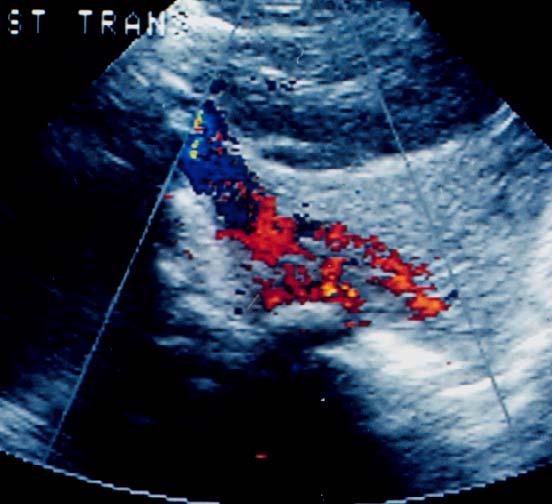 53 Jonathan Shaw, HMS IV Sonogram of Sequestration Aorta A Anomalous Vessel May show
