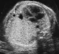 54 Jonathan Shaw, HMS IV Sonogram of Sequestration Can also image prenatally Axial sonogram of chest obtained at 22 weeks gestation