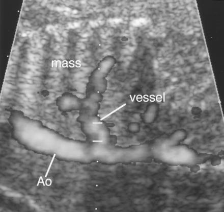 55 Jonathan Shaw, HMS IV Sonogram of Sequestration Prenatal use of Doppler Distinguish sequestration from other congenital thoracic lesions