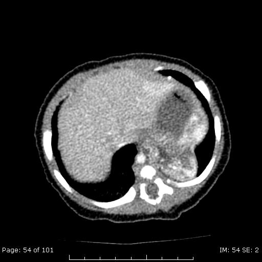 Patient 2 CT of Neonate with L chest mass on prenatal