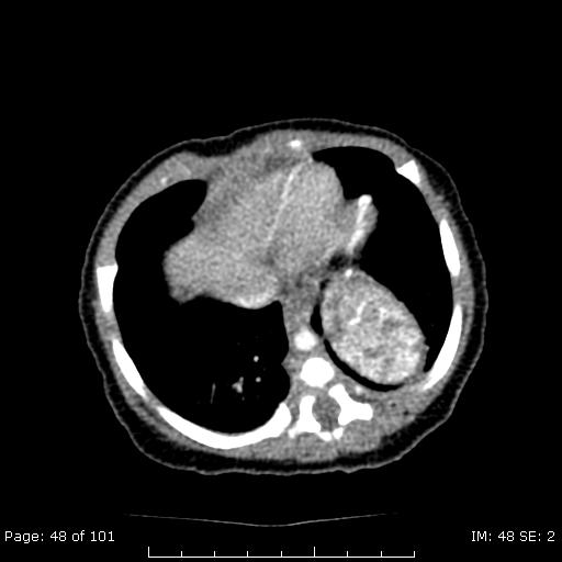 Patient 2 CT of Neonate with L chest mass on prenatal U/S Differential of this congenital pulmonary mass includes: Dipahragmatic hernia Pulmonary