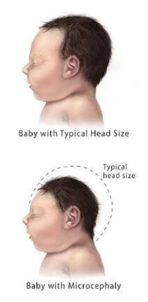 Zika virus infection during pregnancy Can cause microcephaly and other severe brain defects in babies The full range of potential health