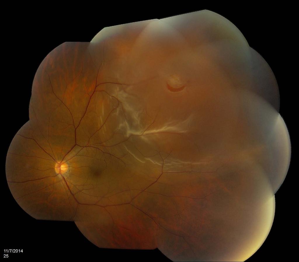 Acute phakic macula-on RD with retinal tear in lattice degeneration