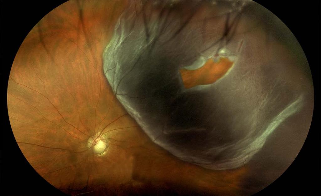 Acute phakic macula-off RD with large retinal tear Management?