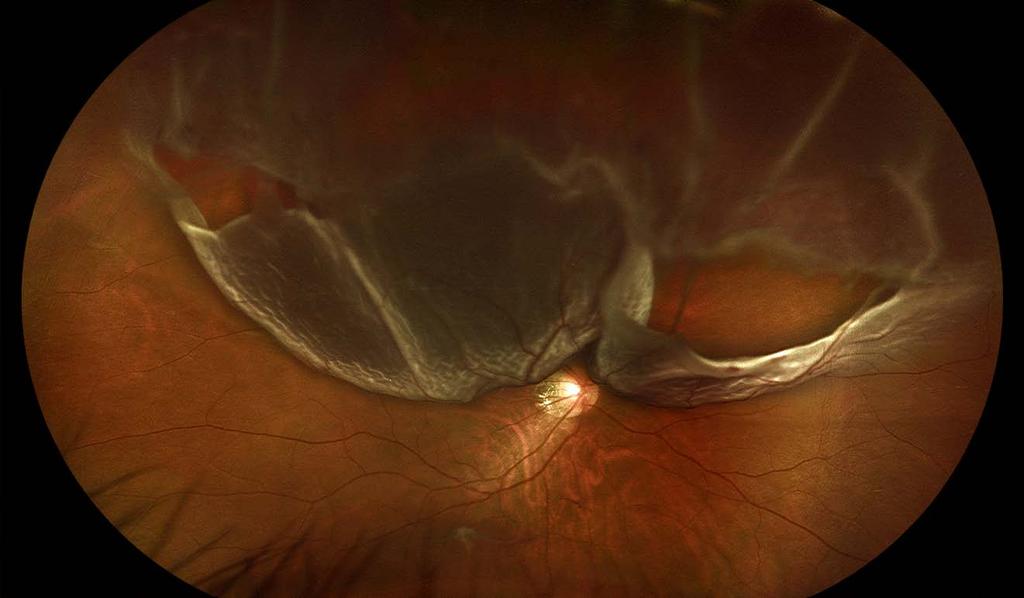 Acute phakic superior macula-off RD with two large retinal tears and