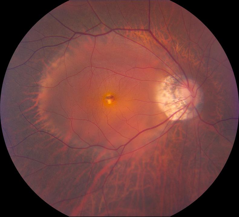 High myope with macular hole and retinal detachment Is there a role