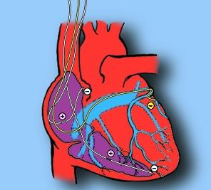 Resynchronization Therapy For Heart Failure Methods: Epicardial Approach Requires thoracotomy Associated morbidity Transvenous Approach As