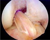 settled down and motion has been restored Intraoperative Factors Affecting RTP Anatomic graft position and tension anatomic graft placement and appropriate tension is critical for successful outcome