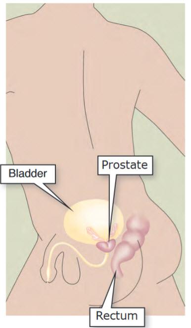 Managing Symptoms after Prostate Cancer Bowel Problems after Radiation If you have bowel problems after radiation, you may feel embarrassed. Don t let this stop you from asking for help.