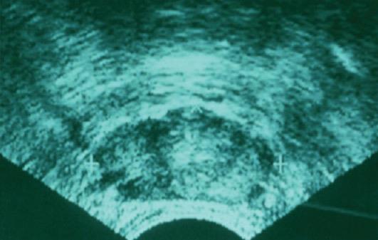 Transrectal Ultrasound Most often used for prostate biopsy Not