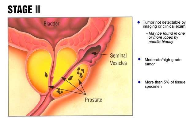 Prostate Cancer T2 Can be felt during DRE (digital rectal exam) T2a felt on less than ½ of one side