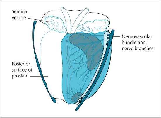 Nerve-sparing Prostatectomy Preserves nerves