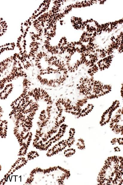 Wilms tumour-1 (WT1) protein in carcinomas/mesotheliomas Serous carcinoma +