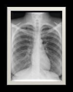 Assessment: Chest X-ray A chest x-ray is indicated any time a patient has a positive IGRA or TST or exhibits signs and symptoms of TB Disease.