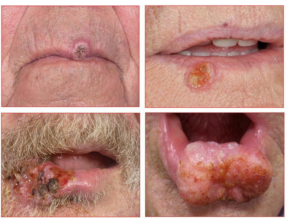 Fig 3. Pictures of four patients with SCC of the lip, treated in the Medical Centre in Leeuwarden (MCL).
