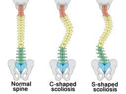 According to MedilinePlus, how well a person with scoliosis does depends on the type, cause, and severity of the curve.