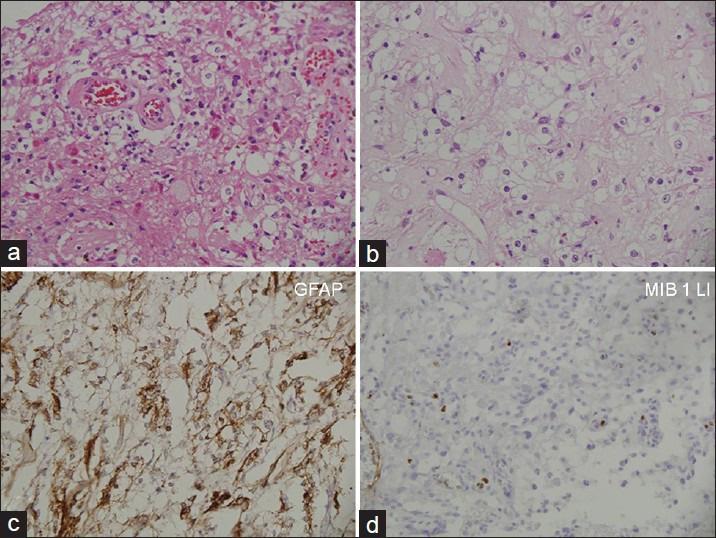 Figure 3 Photomicrographs showing a sparsely cellular tumor with interspersed rosenthal fibers and granular bodies and clearing of cytoplasm of some neoplastic cells (a and b;