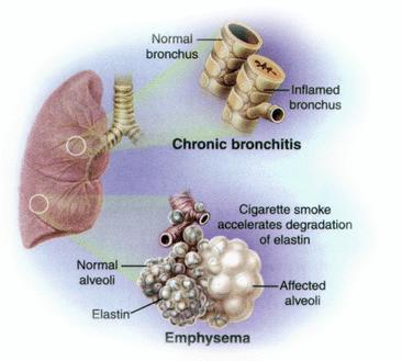 Chronic obstructive pulmonary disease (COPD) is a preventable and treatable disease state characterized by airflow limitation that is not fully reversible.